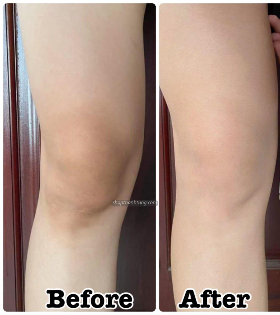 Làm sao để hết thâm đầu gối