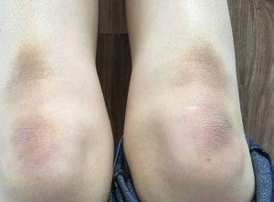 Làm sao để hết thâm đầu gối