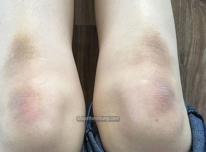 Nguyên nhân thâm đầu gối ở nữ phổ biến nhất