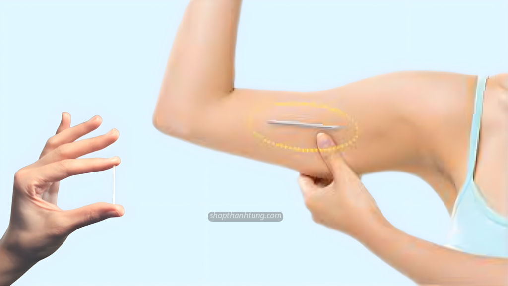 Hiệu quả của cấy que tránh thai