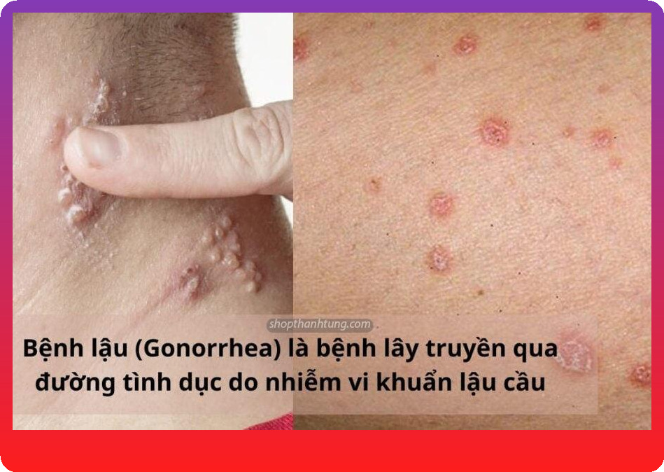 Dấu hiệu nhận biết bệnh lậu cần chú ý
