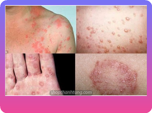 Những biện pháp bổ sung giúp phòng tránh bệnh lậu