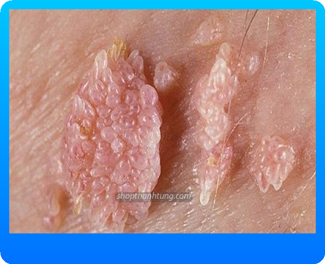 Sùi mào gà là gì