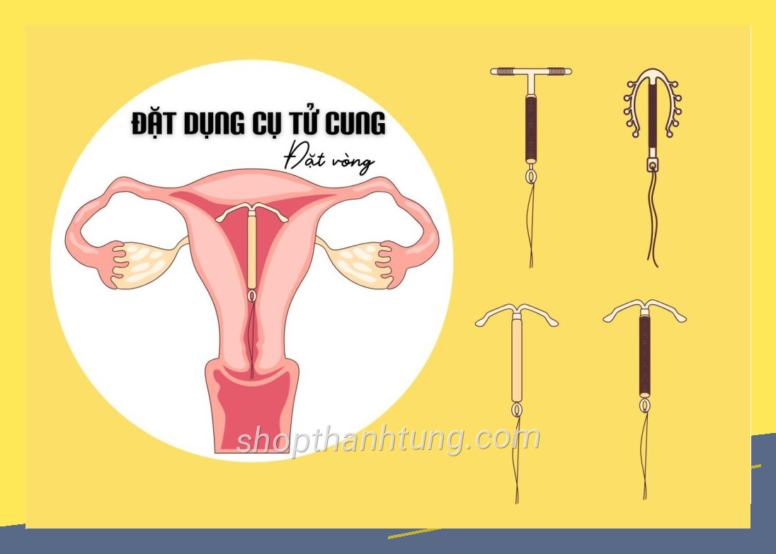 Dat vong tranh thai