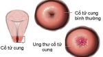 Thiết kế ung thu co tu cung co quan he duoc khong được trình bày rõ ràng