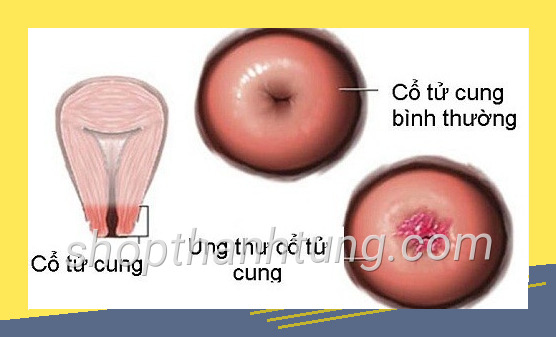 Thiết kế ung thu co tu cung co quan he duoc khong được trình bày rõ ràng