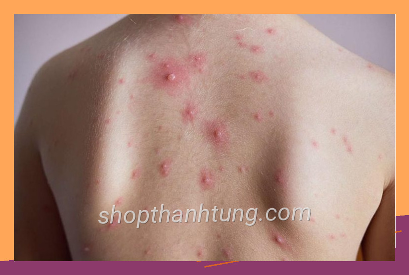 Thủy đậu có gây vô sinh không?