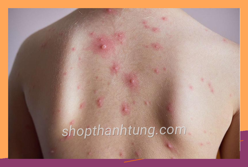Ảnh thực tế benh thuy dau co bi vo sinh khong với bố cục hài hòa