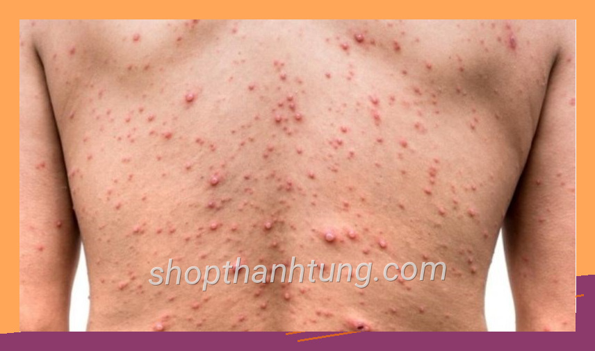 Không gian benh thuy dau lay qua duong nao cach phong ngua 20 800x450 được trình bày rõ ràng