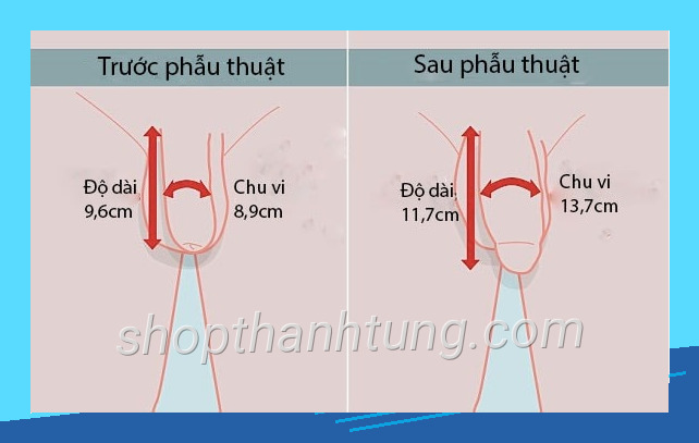 Phau thuat duong vat min